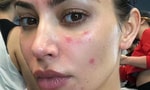 Ким Кардашьян честно рассказала о проблемах с кожей