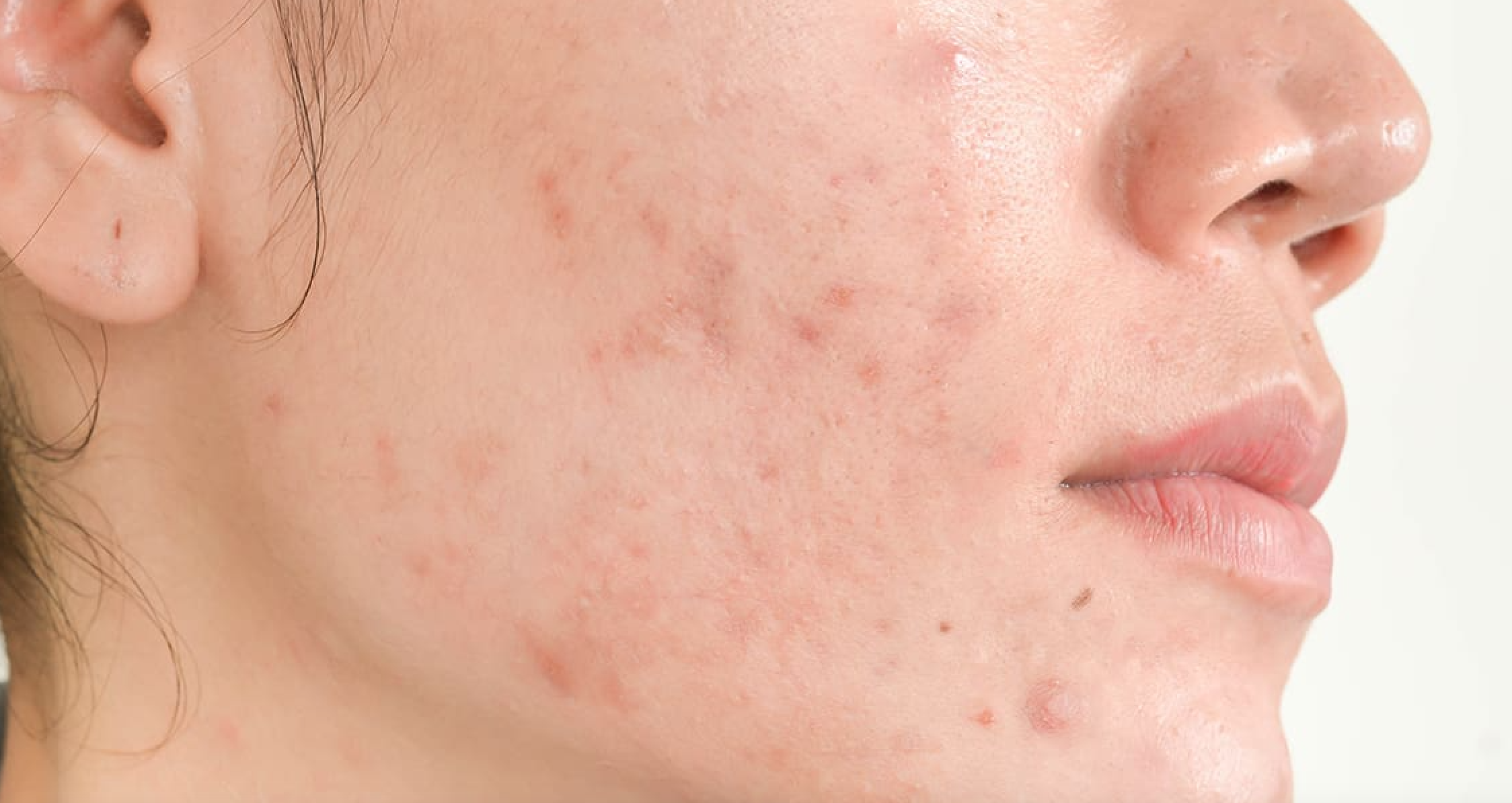 Эксперты рассказали всю правду об акне