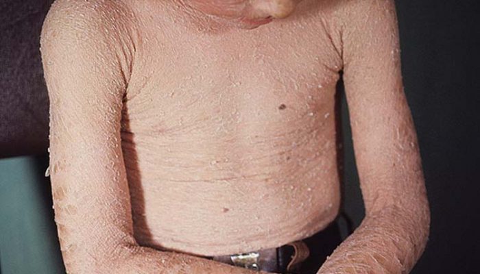 Люди-рыбки. Что такое ихтиоз?