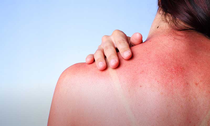 Ожог солнечный: проявления, лечение и профилактика