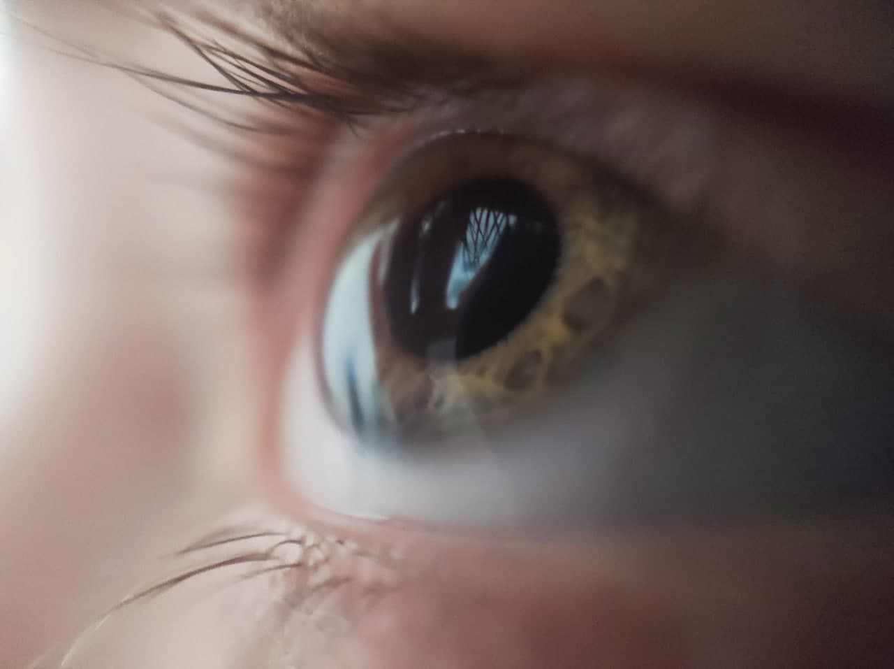 Врачи рассказали, как по глазам определить «скрытого убийцу» в организме