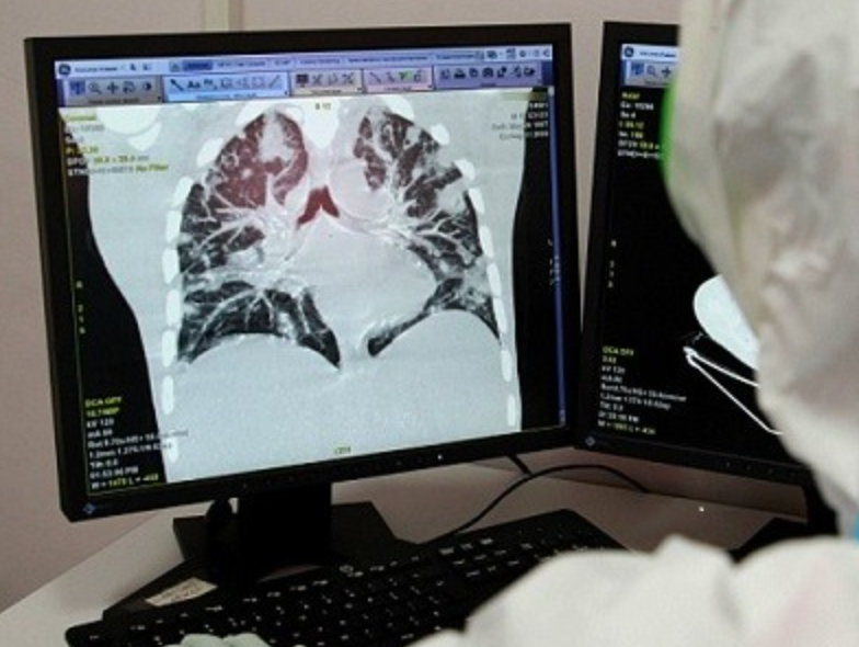 За прошедшие сутки в Узбекистане 4 человека умерли от пневмонии — статистика