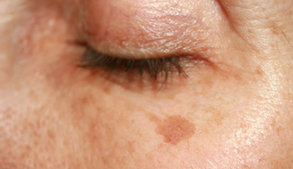 В Минздраве рассказали, почему появляются пигментные пятна