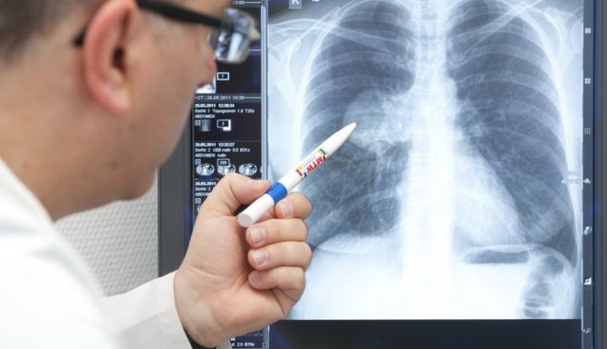 Число выздоровевших от пневмонии узбекистанцев перевалило за 19 тысяч