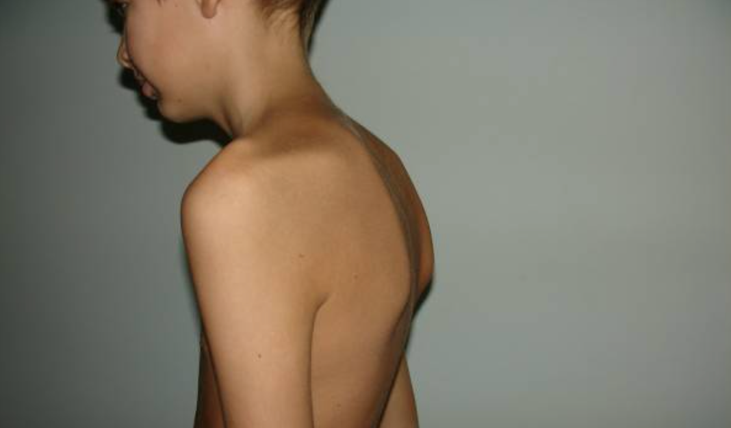 Сколиоз можно вылечить — способ есть