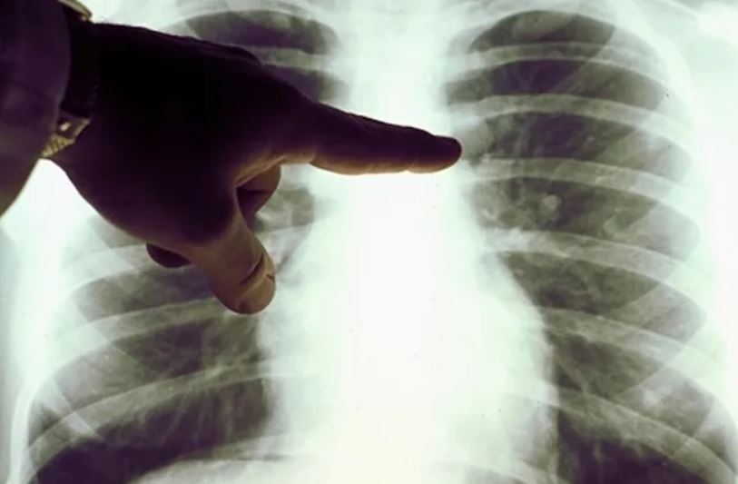 На выходных у 6 узбекистанцев выявили пневмонию 