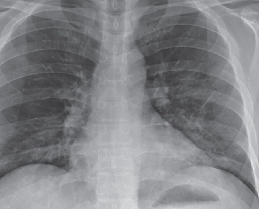 В Узбекистан вернулась пневмония — статистика