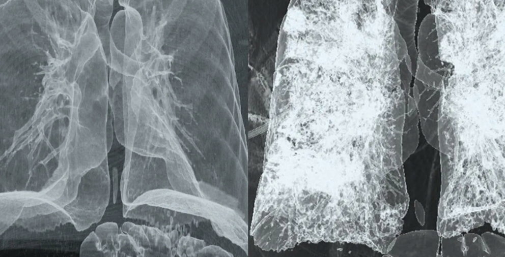 Российский врач рассказал о способе выявить пневмонию при COVID-19