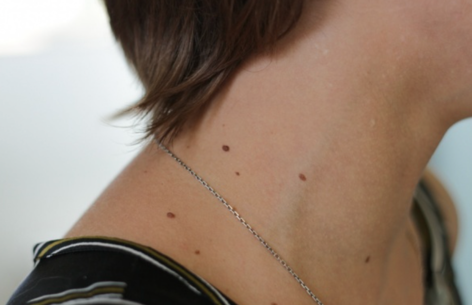 Почему нельзя травмировать родинки? Рассказал дерматолог