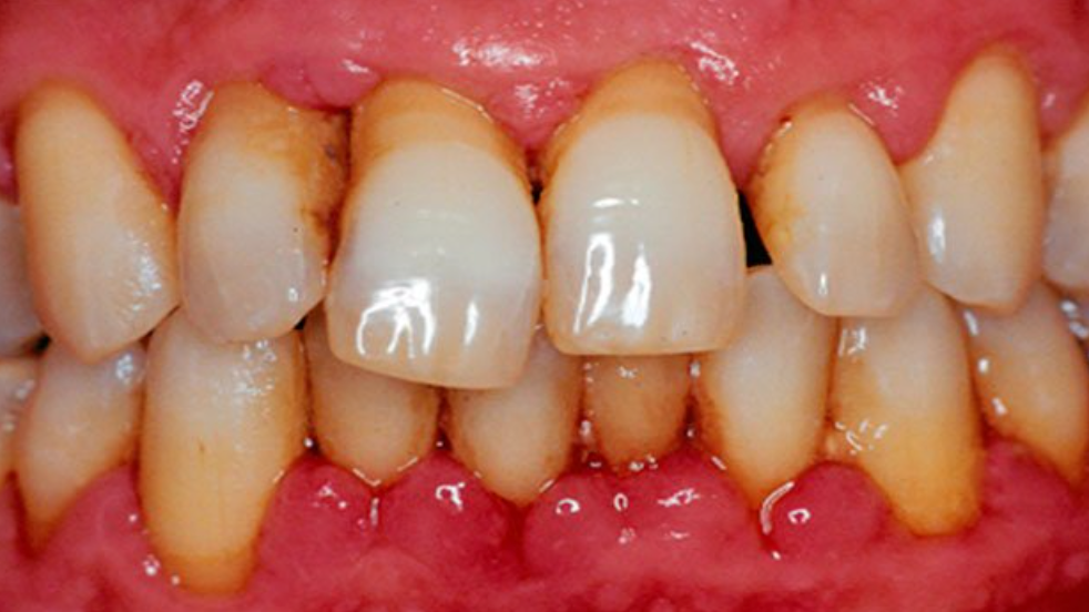 Стало понятно, зачем нужно немедленно заняться лечением десен