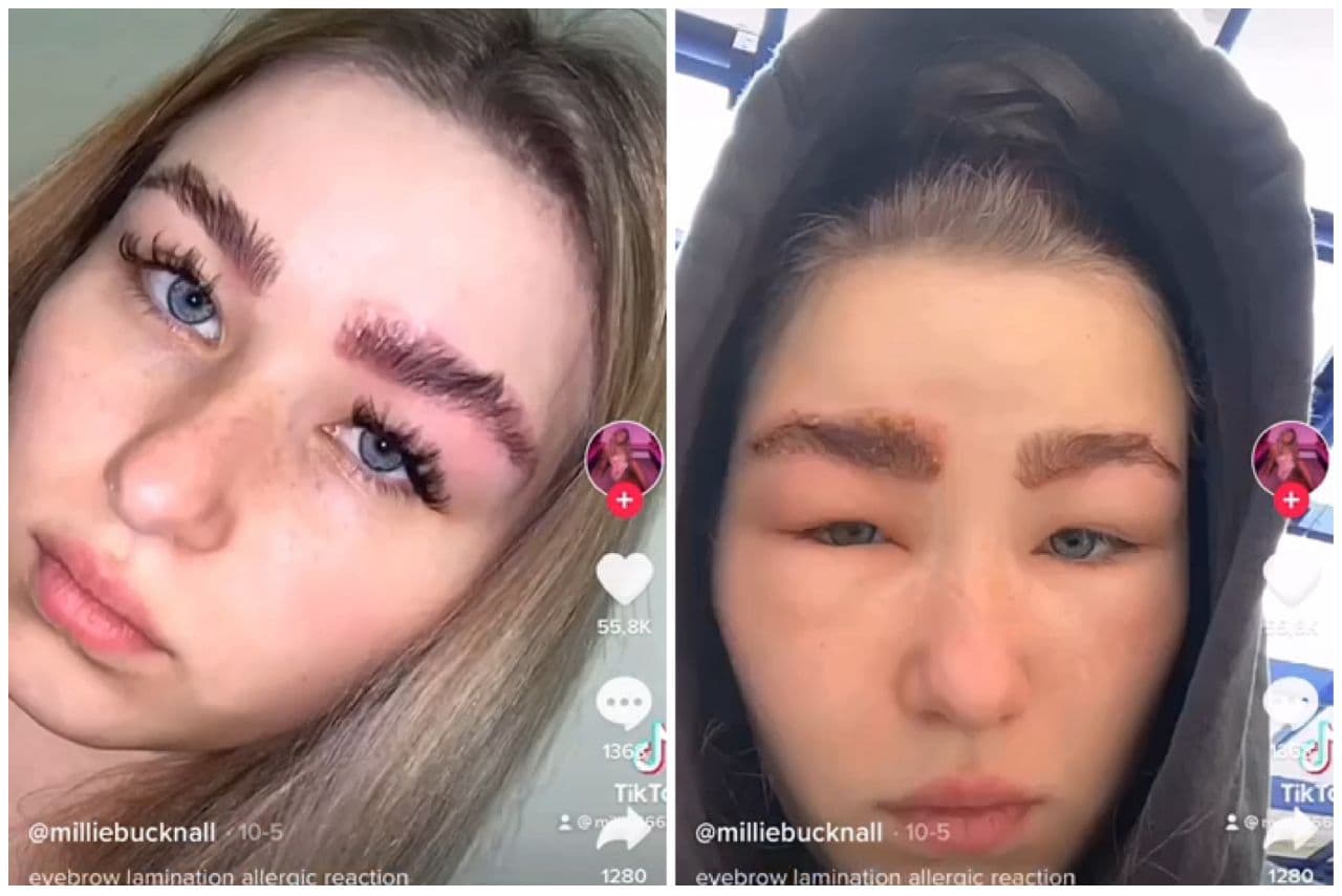 У девушки-блогера распухла голова после одной из салонных процедур для бровей — видео