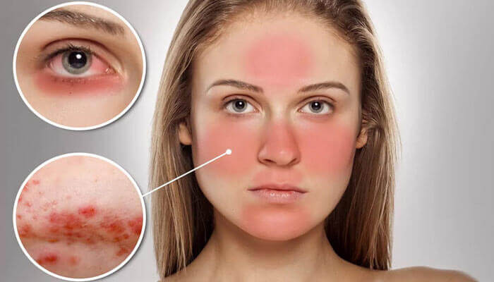 Покрасневшее лицо может быть симптомом заболевания – рассказываем о розацеи