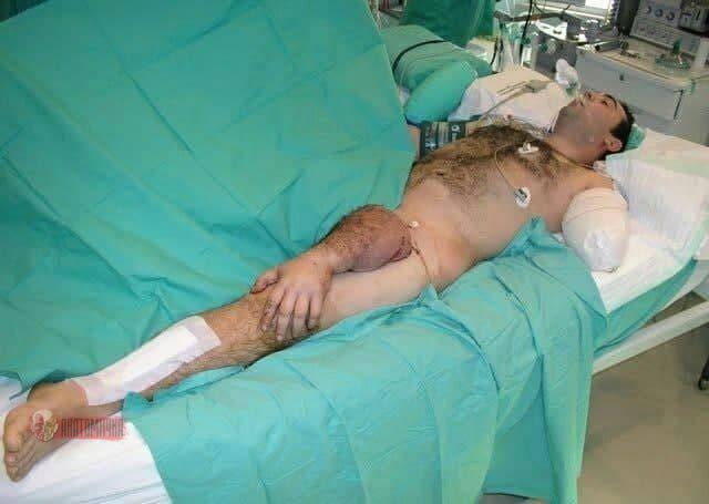 Врачи спасли оторванную руку пациента и пришили ее к ноге — фото