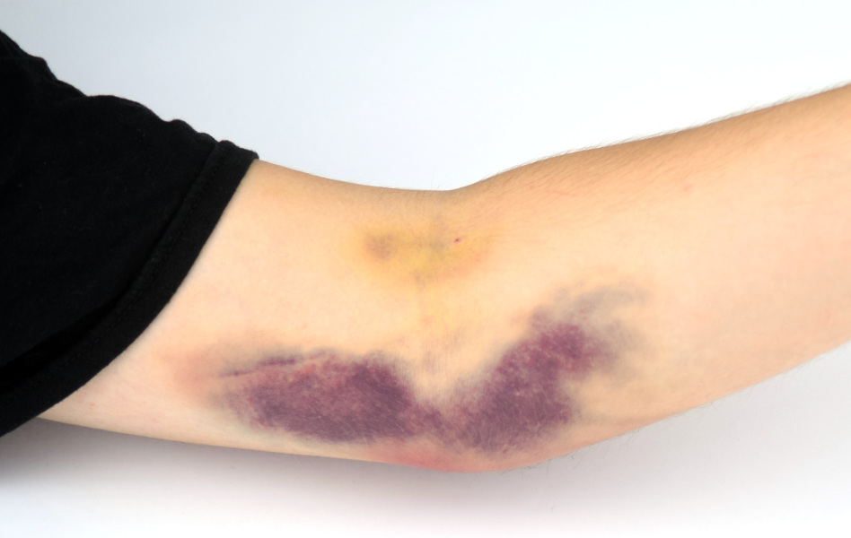 Чем опасны синяки на теле, которые появились без причины после коронавируса