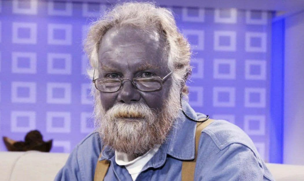 Одно из редчайших заболеваний – синдром синей кожи