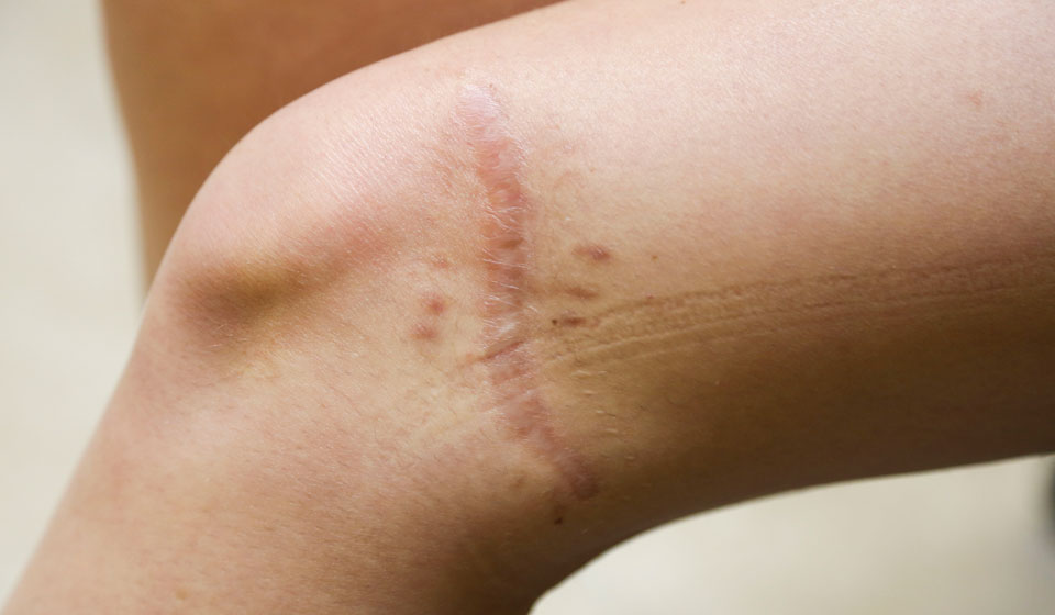 Как избавиться от шрамов и рубцов — 5 народных методов