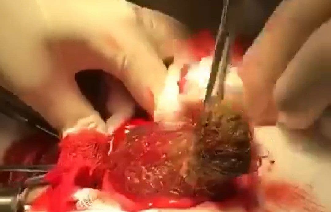 Из желудка маленькой девочки достали 3-килограмовый комок волос, который она съела — к чему приводит синдром Рапунцель