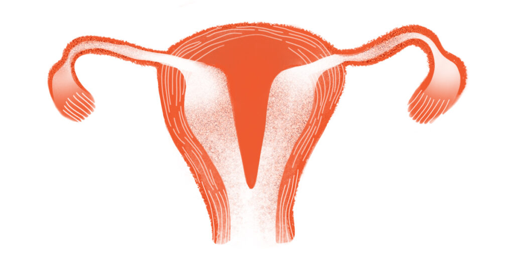 Врачи удалили у мужчины матку вместо грыжи