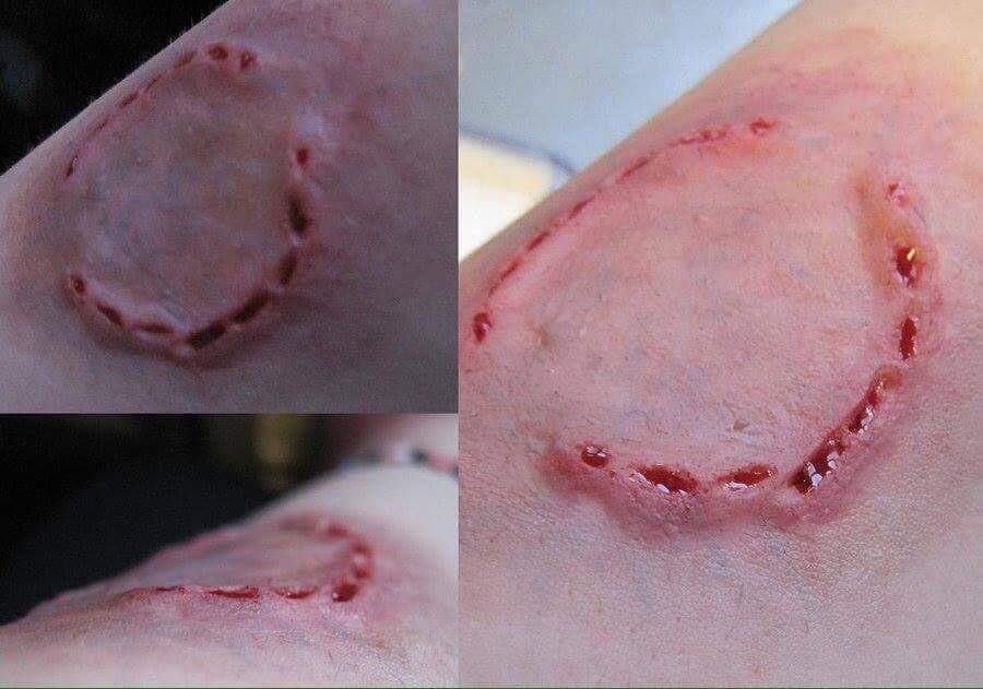 Человеческие укусы могут быть опаснее укусов животных