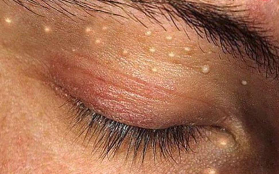 Что такое контагиозный моллюск и почему от него нужно срочно избавляться