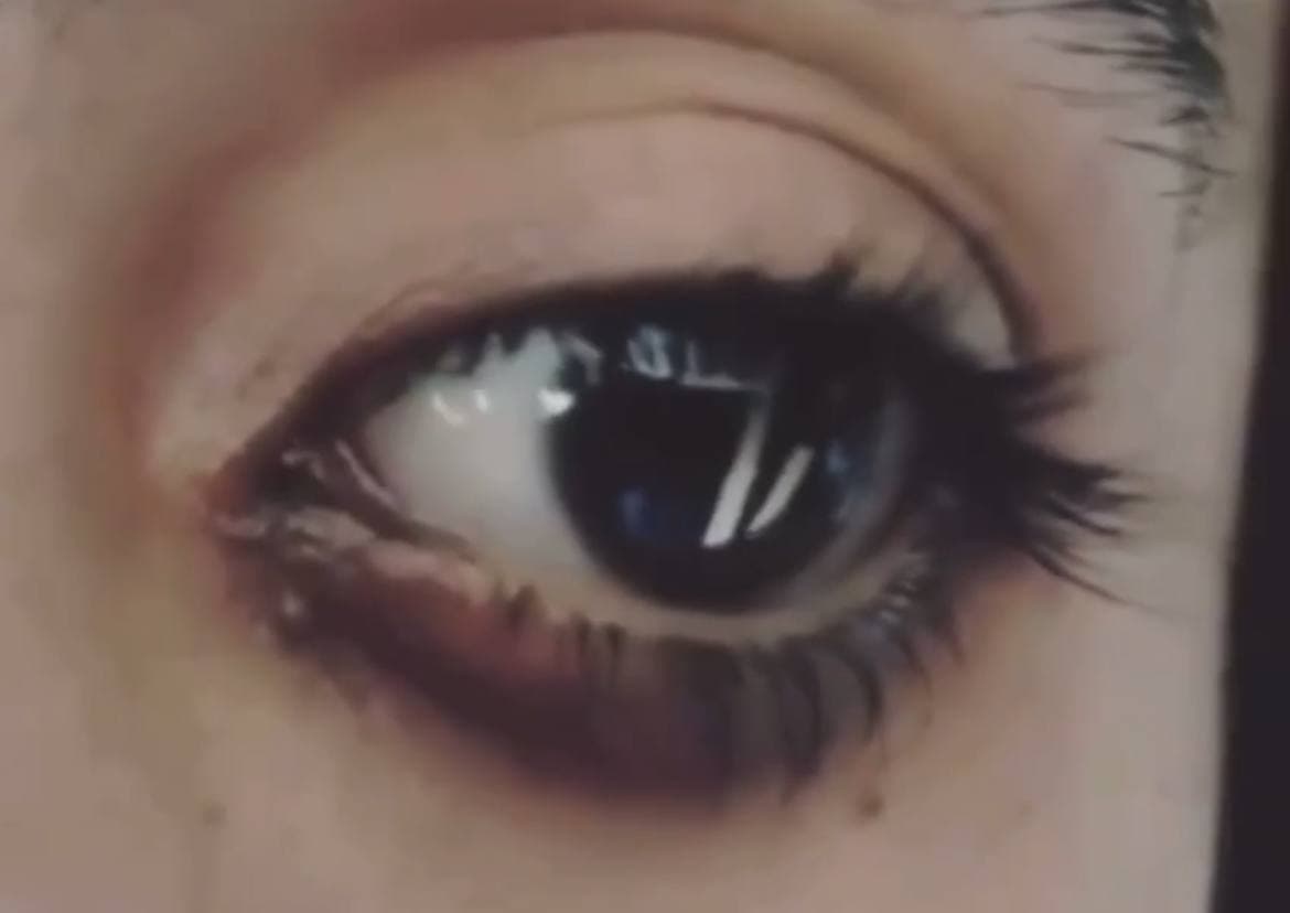 В некоторых случаях пациентам в глаза вставляют имплантат с препаратом – подробности