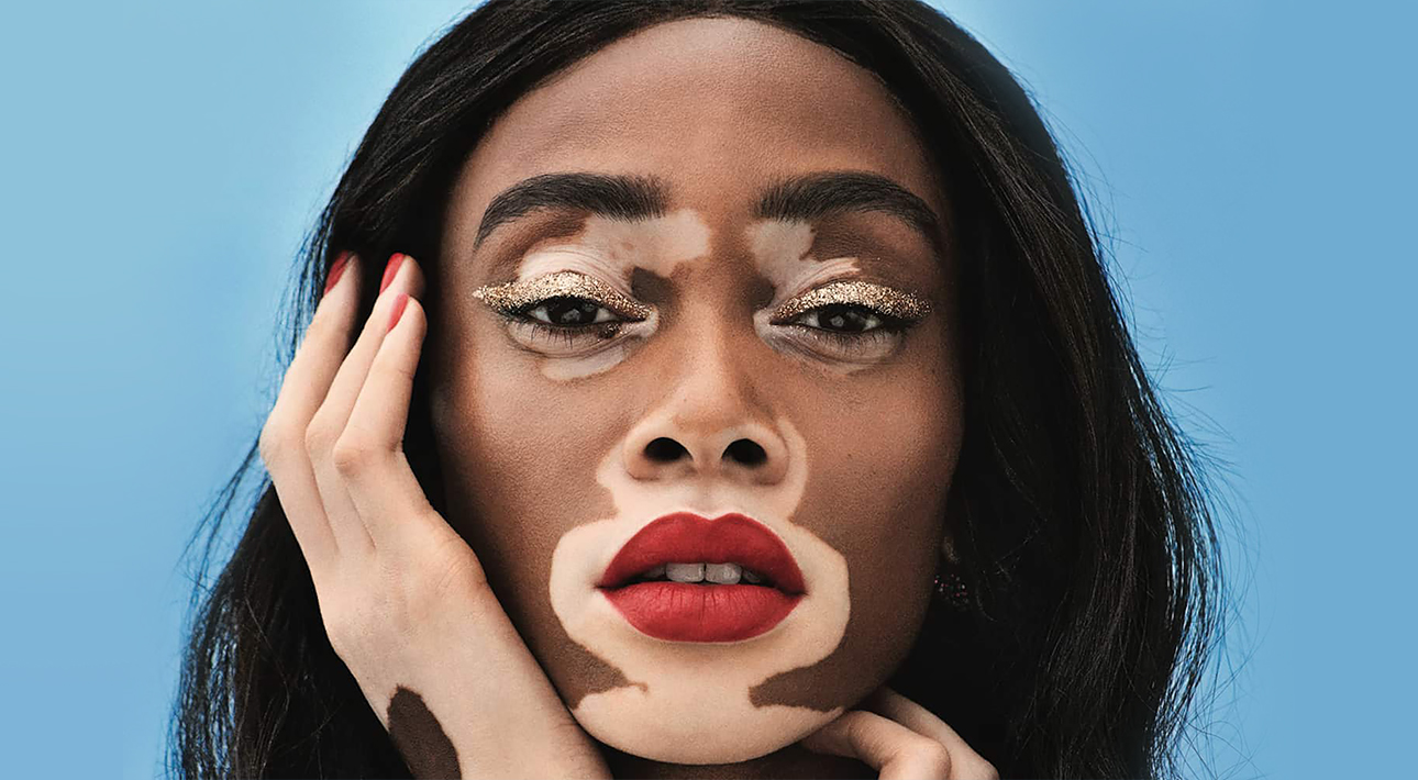 Лечится ли витилиго и почему пятна на коже так быстро растут