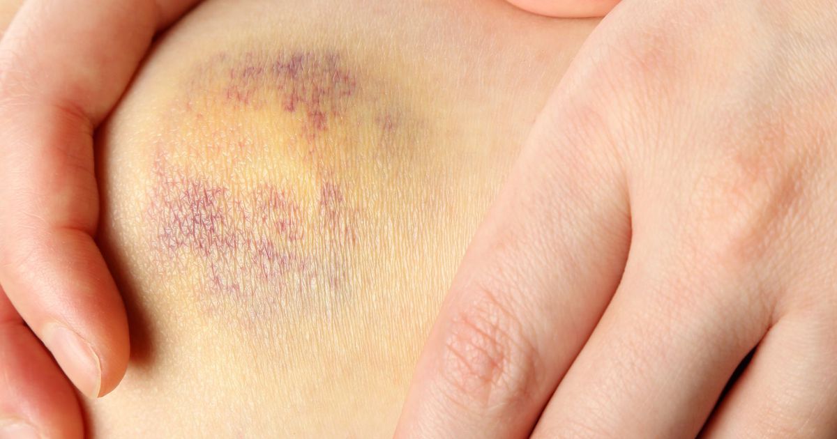 Врач рассказал, чем могут быть опасны синяки — у вас может быть болезнь крови