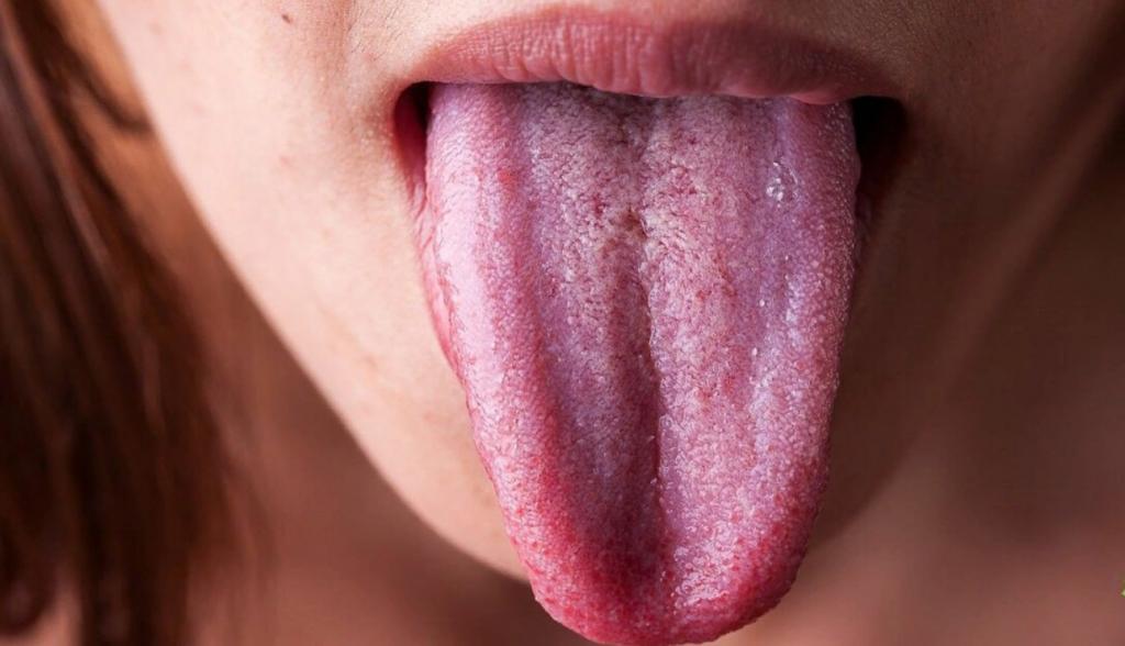 Как по языку определить недостаток витамина В12 в организме и чем это может грозить