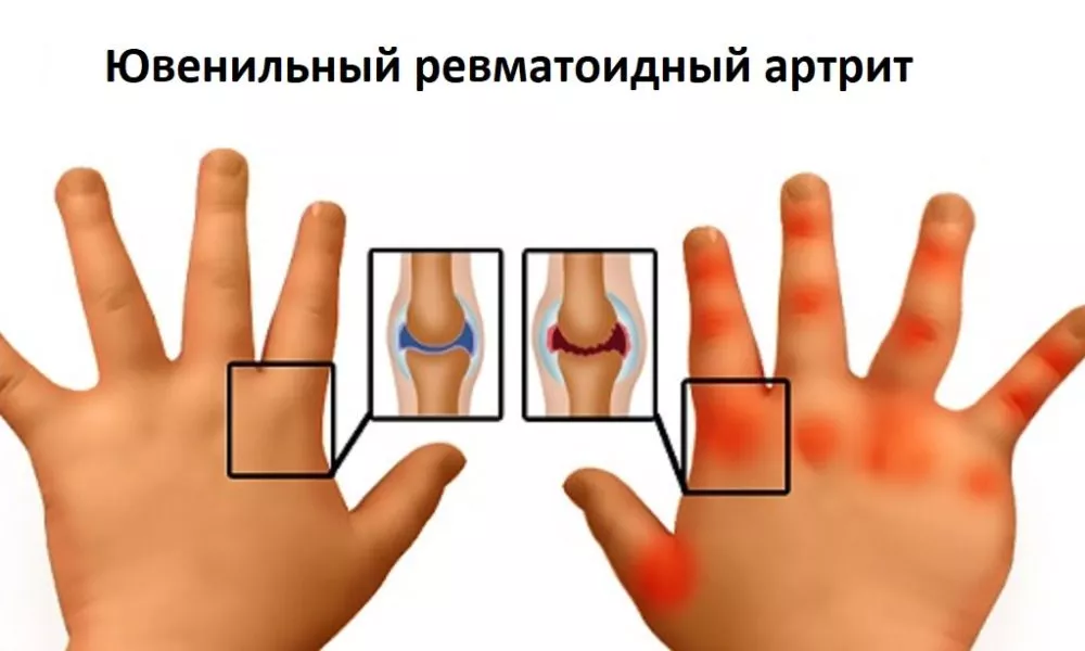 Педиатр из Узбекистана рассказал, как распознать ювенильный ревматоидный артрит у детей и как его лечить