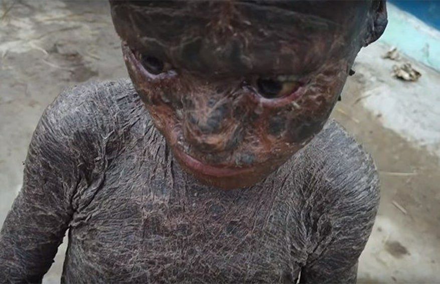 У мальчика на фото — редкое генетическое заболевание «пластинчатый ихтиоз». Рассказываем, что это такое