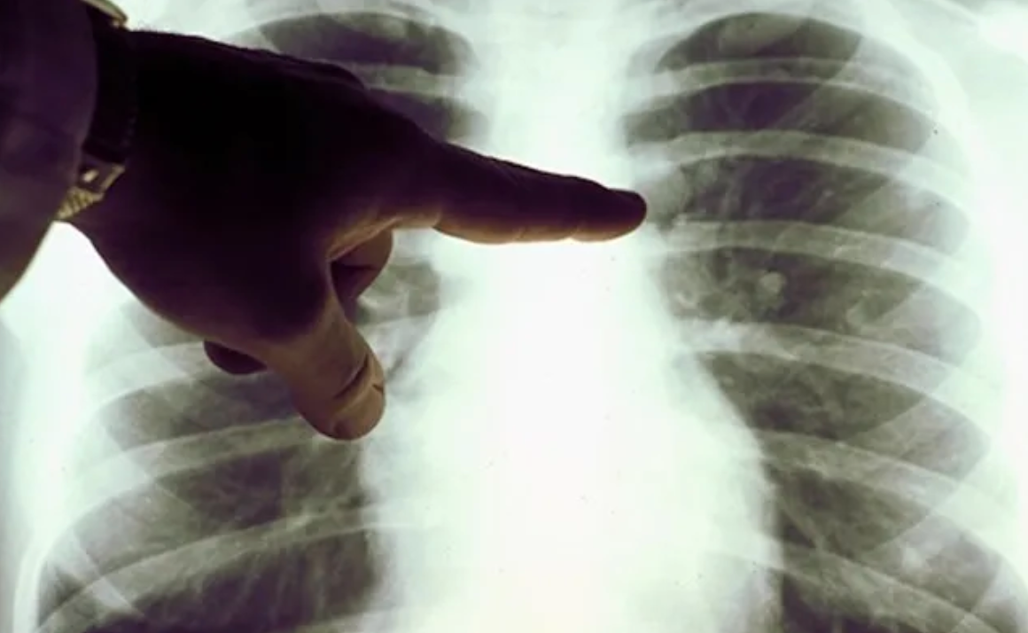 В Узбекистане еще три пациента умерли от пневмонии