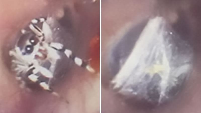 В Китае паук сплел паутину в ухе пенсионерки и прожил там неделю