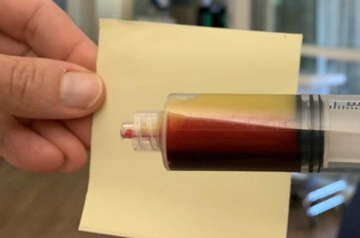 Так выглядит кровь с повышенным содержанием жиров — что к этому приводит?