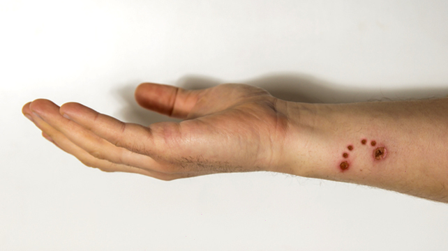 Как человек заражается бешенством и как вирус распространяется в организме?