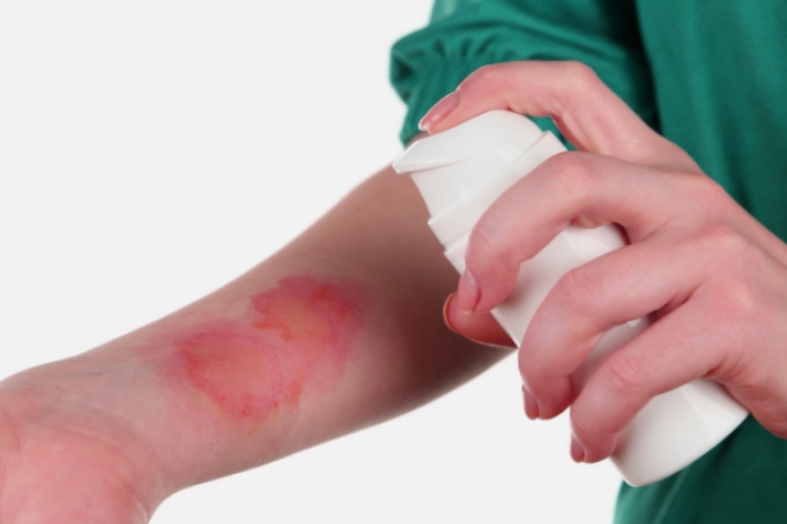 Что делать при разных видах ожогов