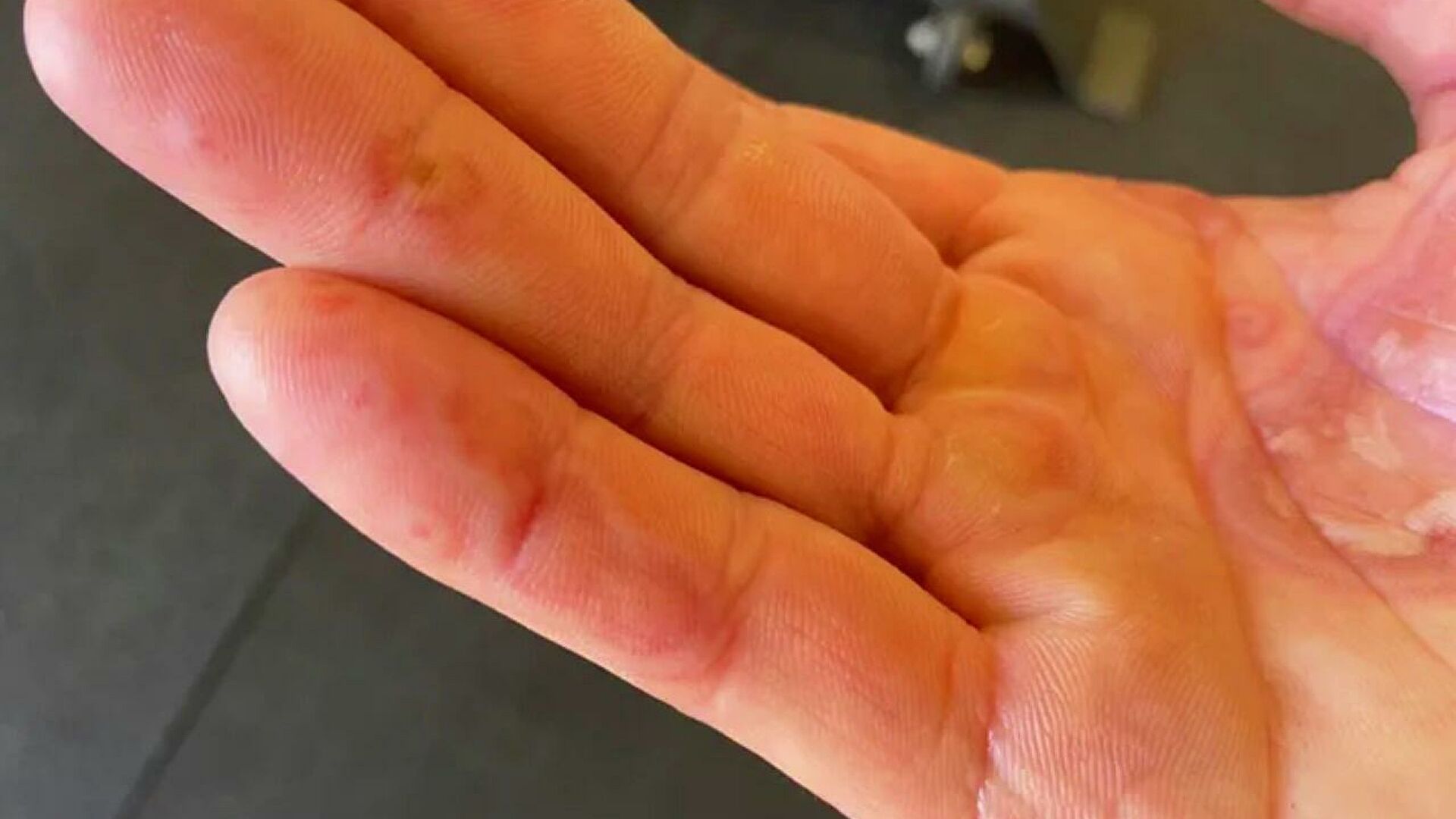 Дерматолог поведала о «ковидной руке» после вакцинации