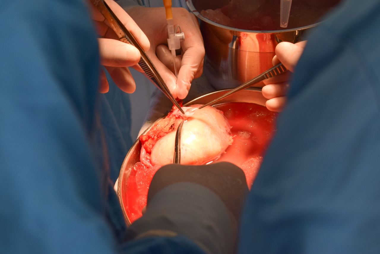 Как обстоят дела с пересадкой почек в Узбекистане — рассказываем