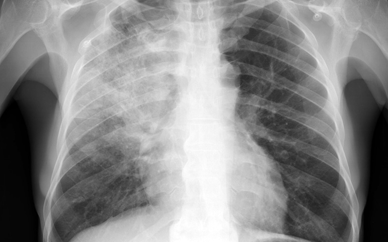 За прошедшие сутки в Узбекистане умерли еще 4 человека от пневмонии — статистика