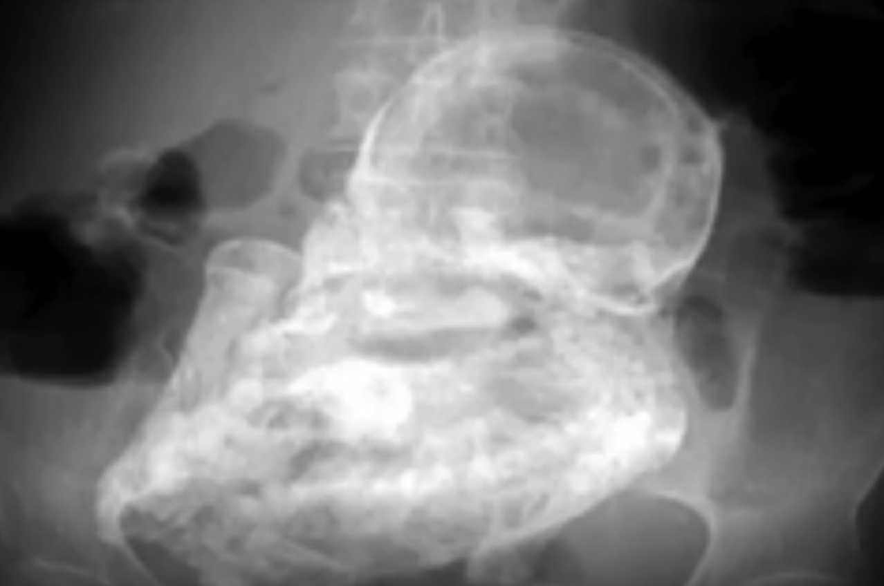 Недоразвитый сиамский близнец превратился внутри женщины в опухоль с зубами и волосами — пациентку прооперировали