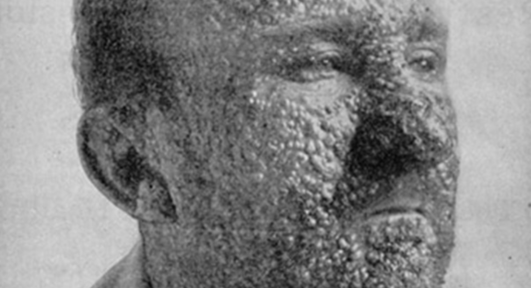 Какие болезни человечество победило благодаря вакцинации?