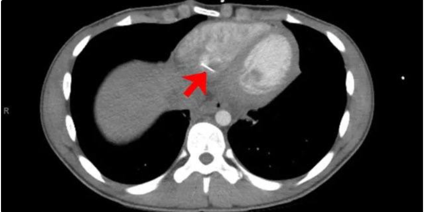 В сердце молодого человека попала булавка, ее удалили