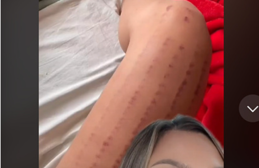 Блогер осталась с глубокими ожогами после лазерной эпиляции