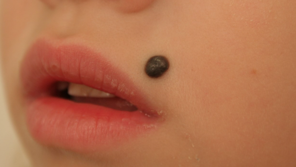 Что делать, если вы содрали родинку? 