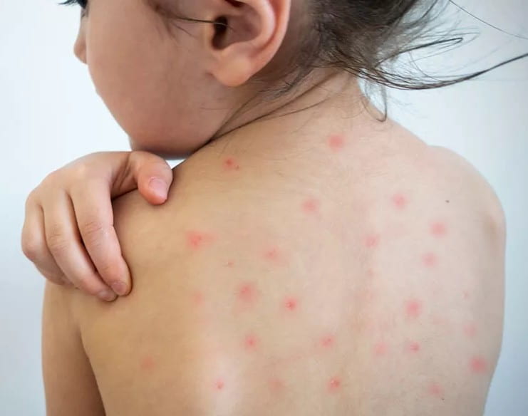 Неонатолог из Узбекистана раскрыла подробности краснухи у детей