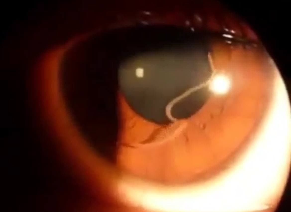 Узнайте о паразите, который проникает в организм человека и добирается до глаз — видео