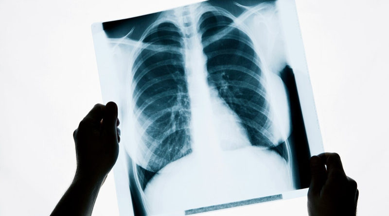 В Минздраве поведали об еще трёх умерших пациентах от пневмонии