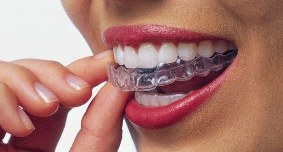 Что лучше выбрать: брекеты или каппы-элайнеры