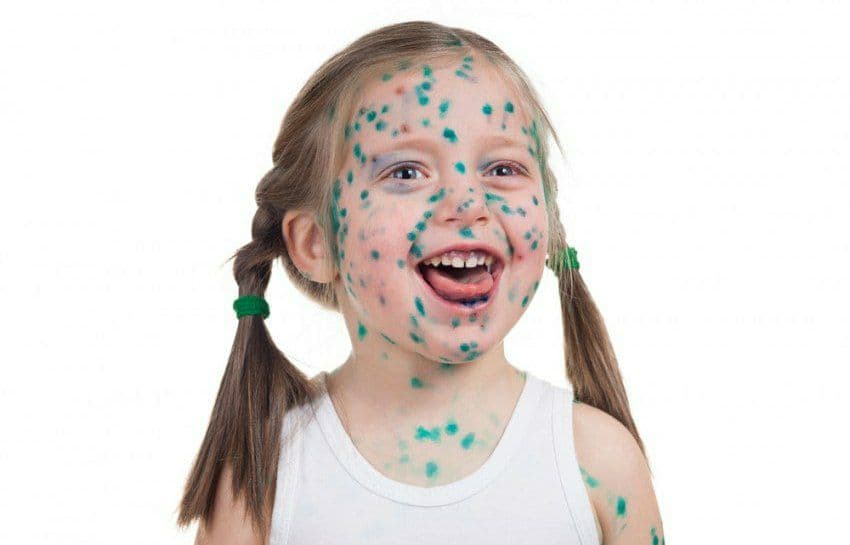 Узбекский педиатр рассказал, к каким осложнениям может привести ветрянка