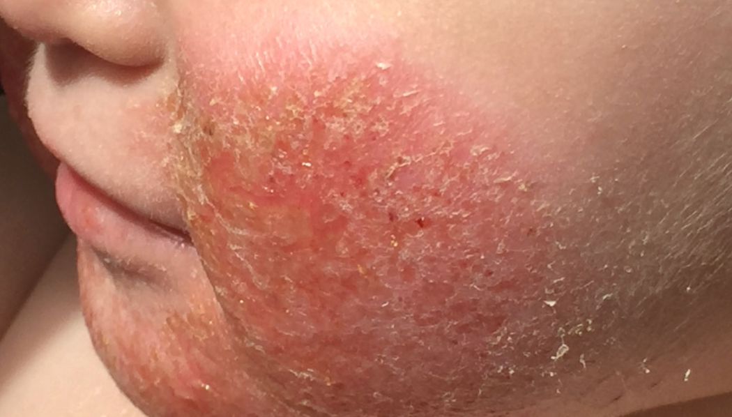 Аллергия может помочь в борьбе с коронавирусом — очень неожиданно