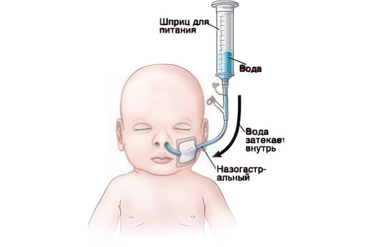 Назогастральный зонд у детей / Фото: fairview.ru